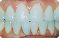 Before After Gallery One Loudoun Dental Clinic